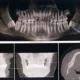 Gums Depigmented