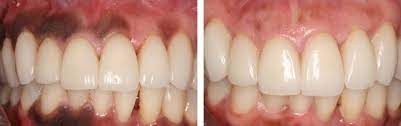 Gum depigmentation