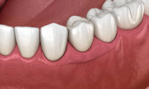 denture repair service