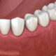 denture repair service