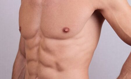 gynecomastia treatment