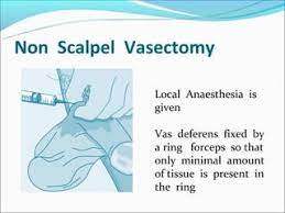 No Scalpel Vasectomy