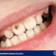 Periodontal Therapeutics Market