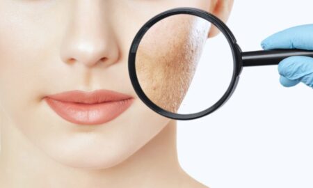 acne scar removal Singapore