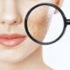 acne scar removal Singapore